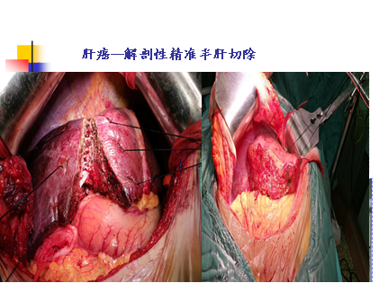 肝胆外科治疗特色技术：肝胆胰脾门脉系统的复杂高危手术