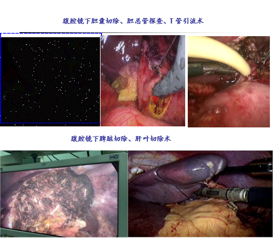 肝胆外科治疗特色技术：腹腔镜手术