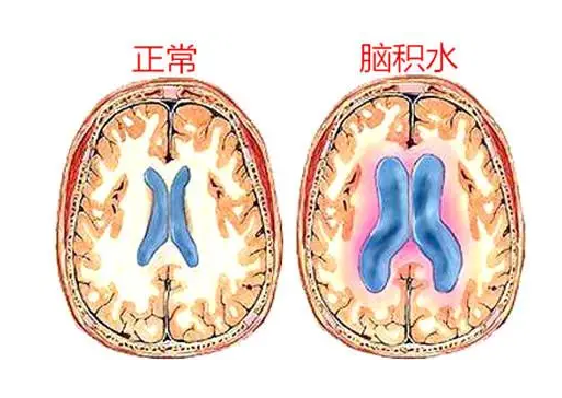 成都哪里可以做新生儿先天性脑积水？