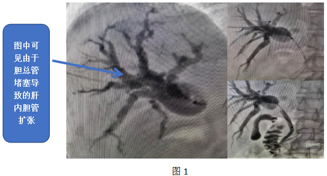 胆道系统疾病的介入治疗