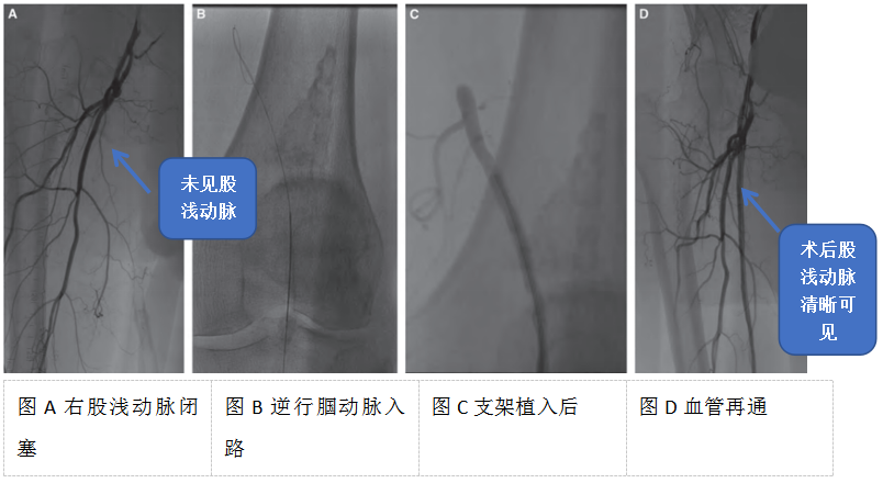 外周动静脉疾病介入治疗