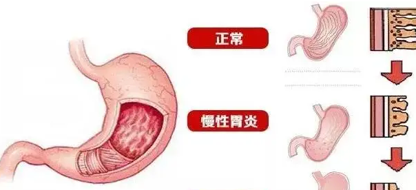 成都慢性胃炎和急性胃炎有什么区别？