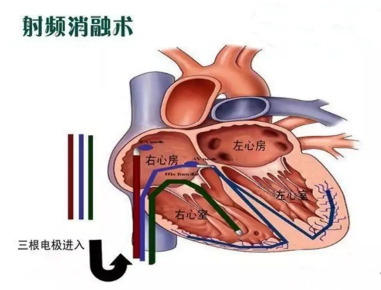 哪些心率快的儿童需要做射频消融术？