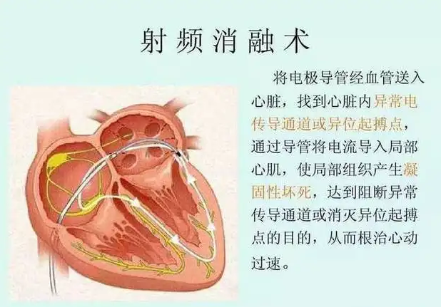 射频消融手术是什么手术