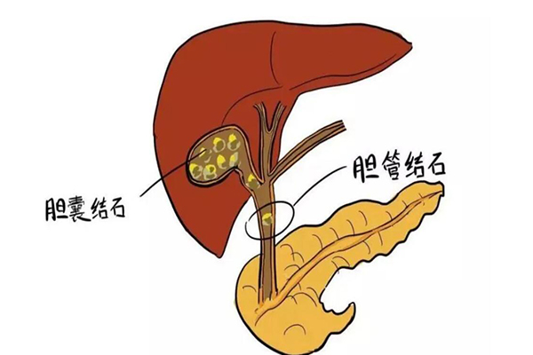 胆结石严重胆囊会被切除吗该如何治疗