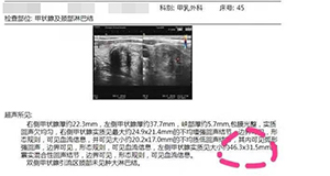 腔镜下甲状腺大肿瘤切除