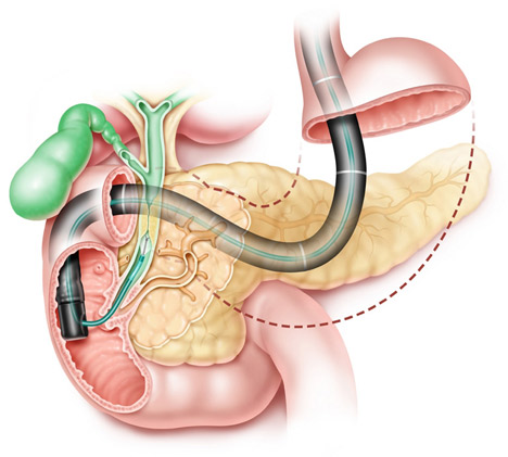 消化内镜中心经内镜逆行胰胆管造影（ERCP）