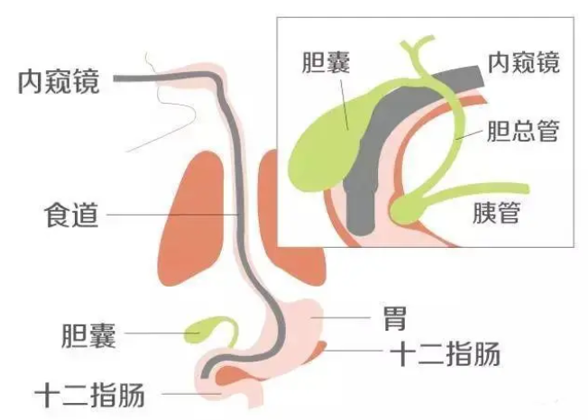 四川大众健康网|男子胆管结石反复发作，9年4次胆道手术，关键时刻ERCP来救命！