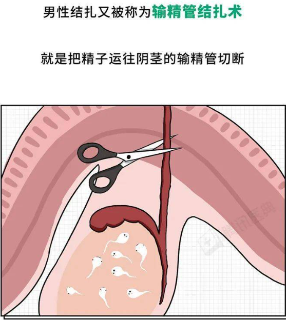 男人结扎手术怎么做的需要多少钱？