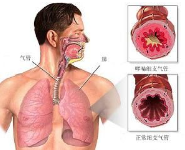 止咳化痰治疗气管炎新华医院为您支招稳妥靠谱