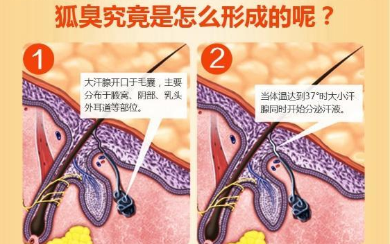 狐臭做手术大约多少钱|狐臭应该挂哪个科?