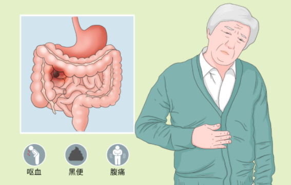 消化道隐形杀手作祟，腹腔肿瘤切除术一次性“拆弹”成功